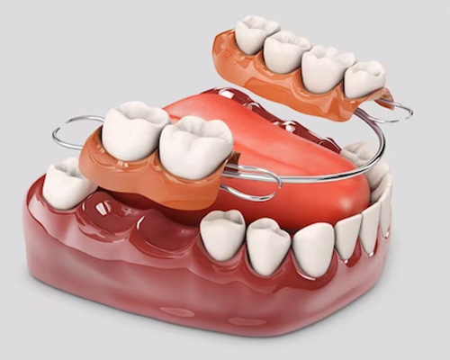 Dentures in Vijayawada